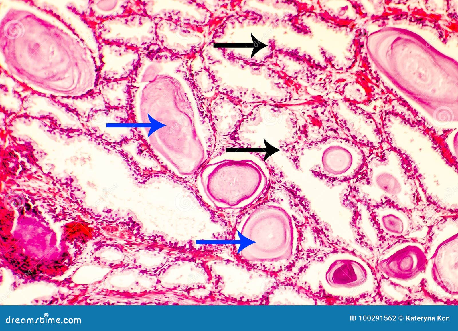 hiperplasia de próstata hiperplasia de próstata