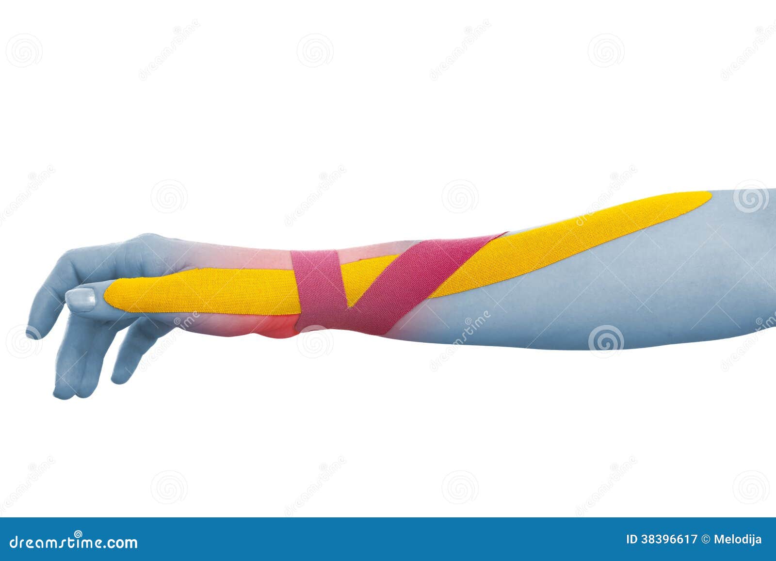 Physical Therapy tape isolated on white. This kind of taping is called Kinesiotape. Its purpose is to detonisize the muscle to reduce pain. In some cases you can also tonisize the muscle.