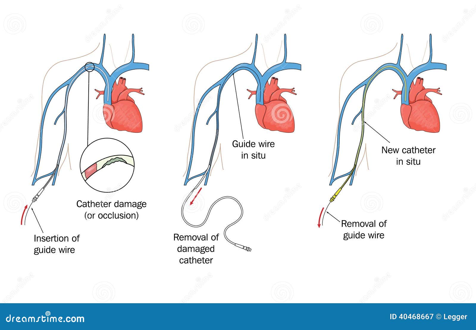 PICC-vervanging vector illustratie. Illustration of illustratie - 40468667