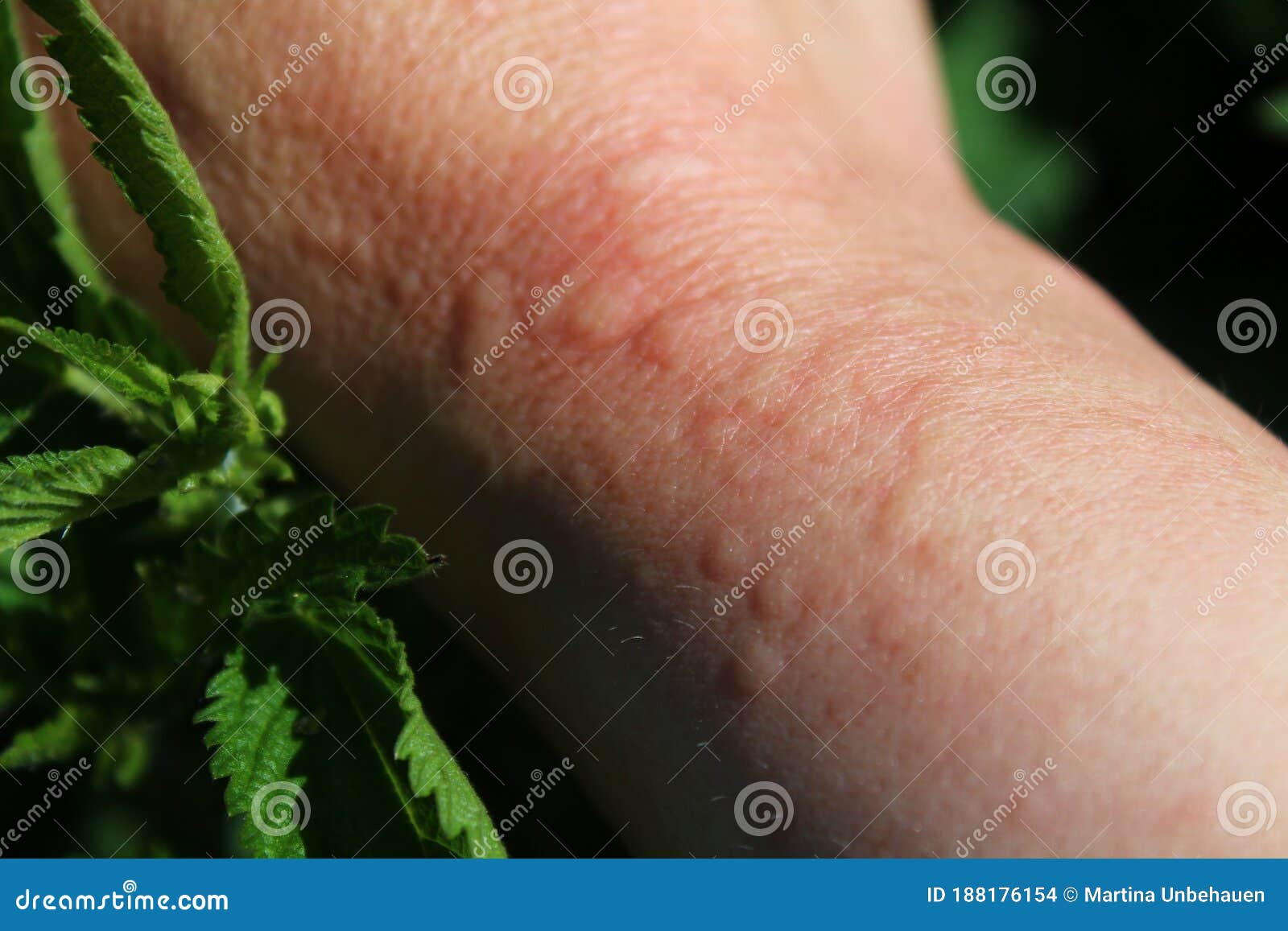 Stinging Nettles And An Arm With Nettle Stings Stock Photo Image Of