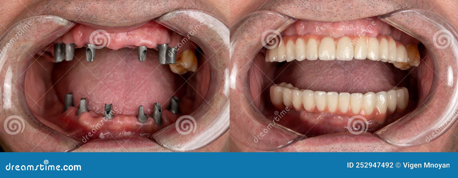 Before and after Pictures of Dental Implants and Press Ceramic Crowns Stock Photo Image of