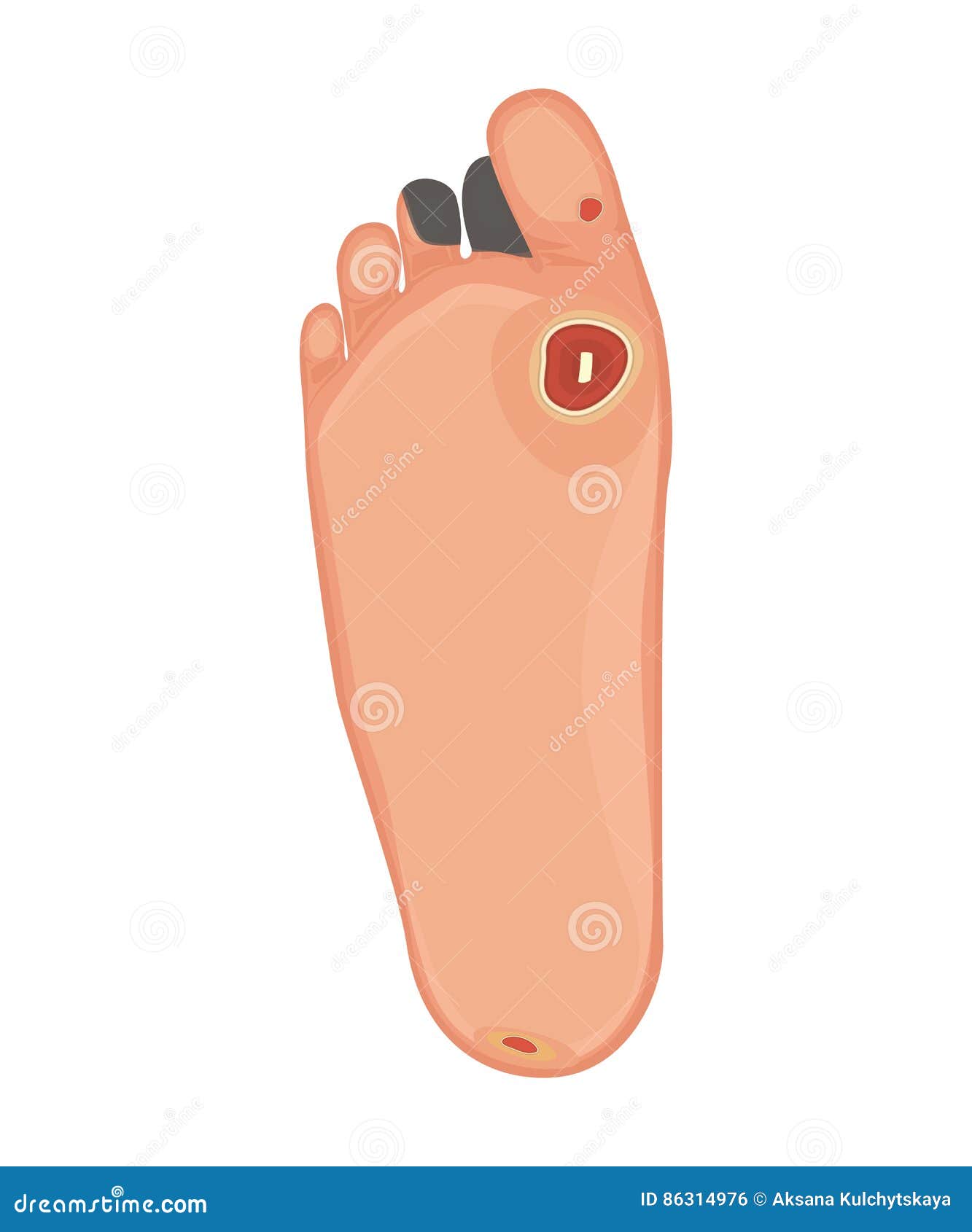 Pie Diabético Isquemia Y Neuropatía Ilustración del Vector