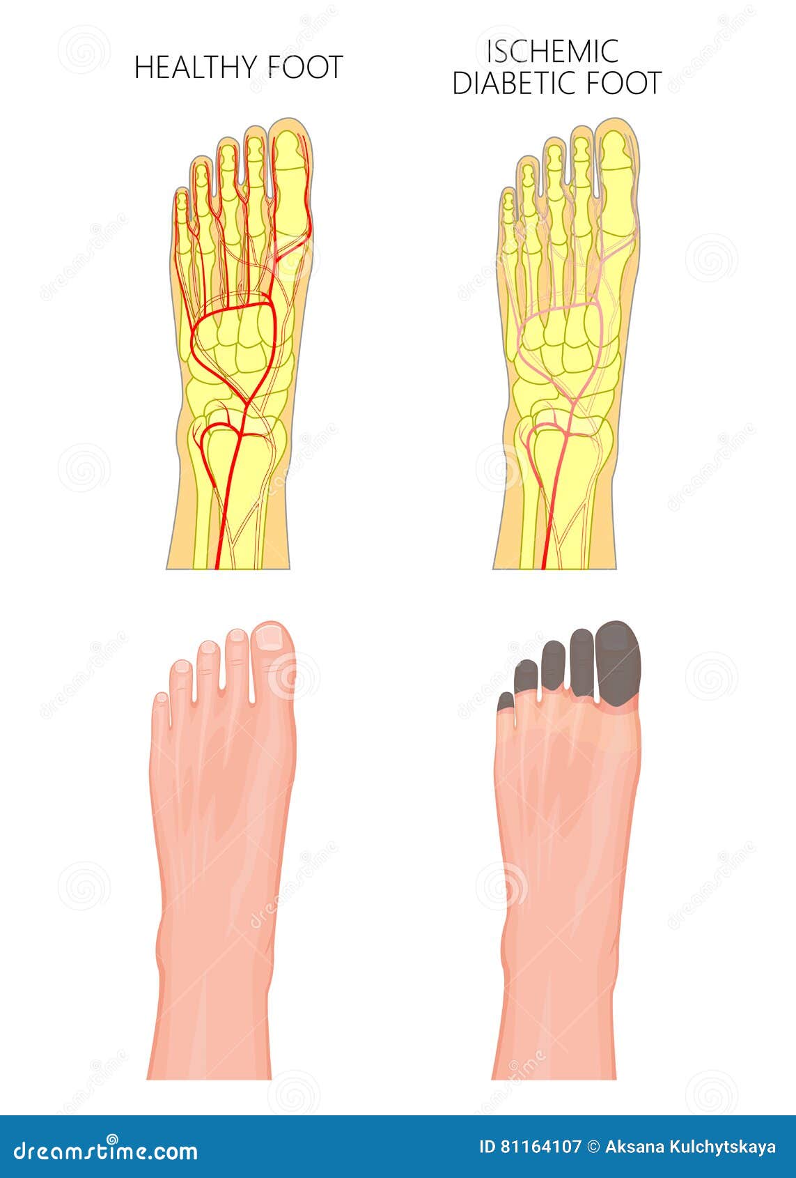 Pie diabético isquémico ilustración del vector. Ilustración de cuidado
