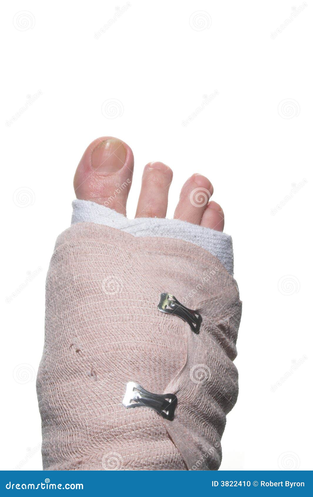 Pied Casse Photo Stock Image Du Rectification Moulage Pied Casse Photo Stock Image Du Rectification Moulage