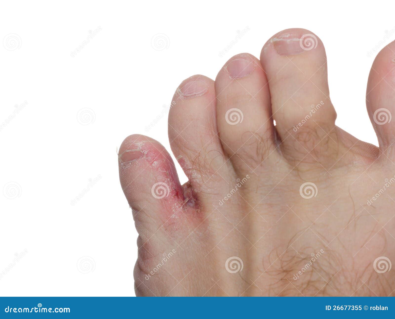 Piede Dell'atleta (pedis Del Tinea) Immagine Stock Immagine di cura