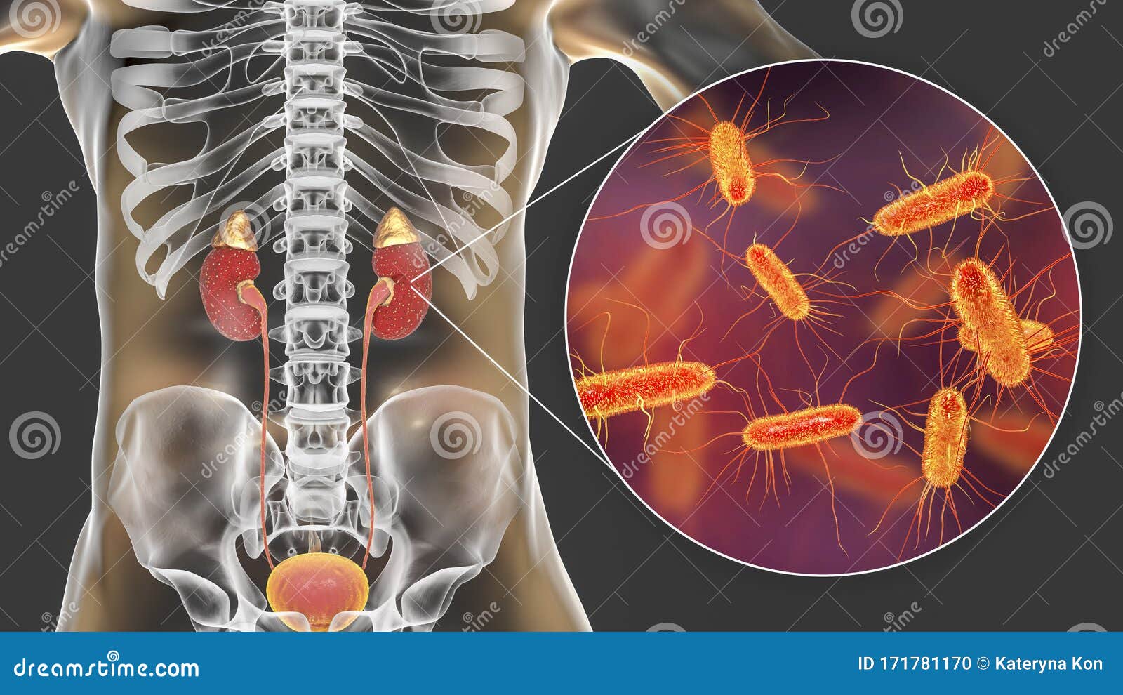 Pielonefritis Aguda Causada Por Bacterias Escherichia Coli Concepto