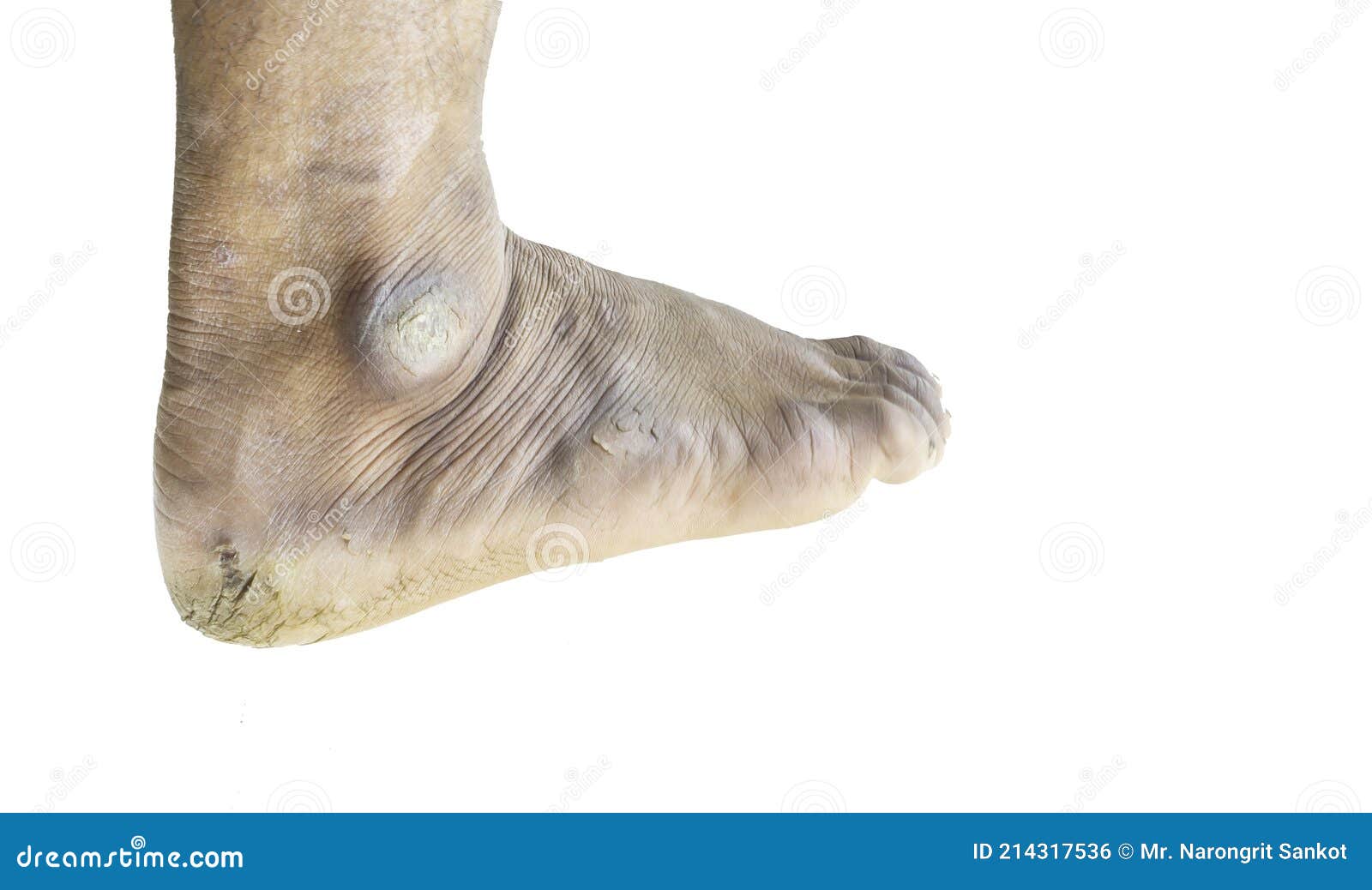 Pies agrietados foto de archivo. Imagen de malo, pedicura 214317536