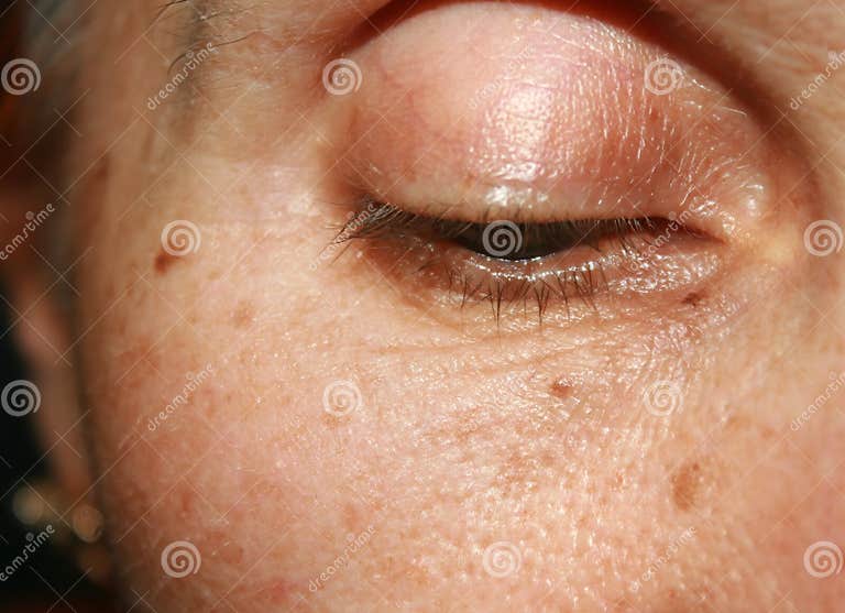 Pigmentation Sur Le Visage Tache Brune Rides Sur La Paupière Et Sous L