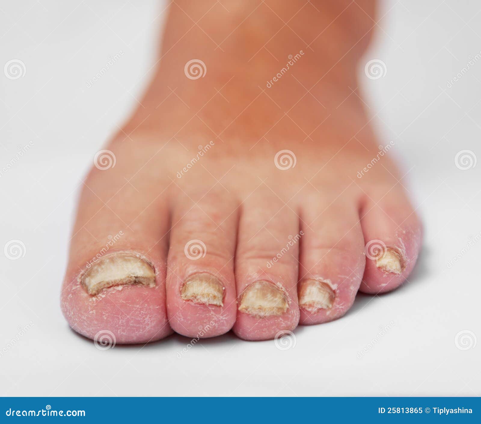 Pilzartige Krankheit stockbild. Bild von krankheit, unannehmlichkeit