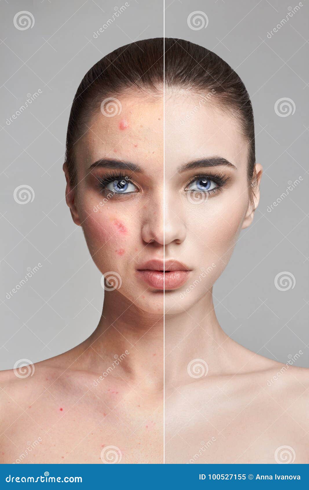pimples and acne on the woman`s face before and after. cosmetics