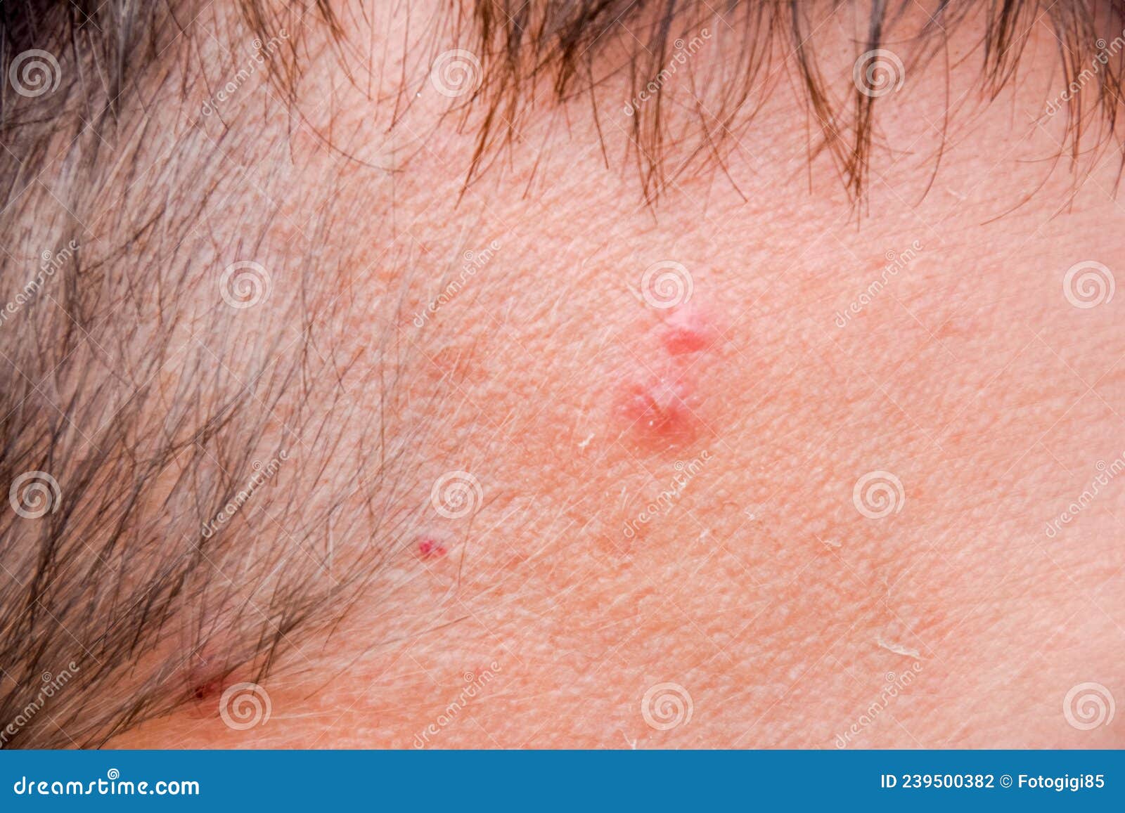 Pimples On The Forehead Of Man Acne On The Forehead Stock Photo