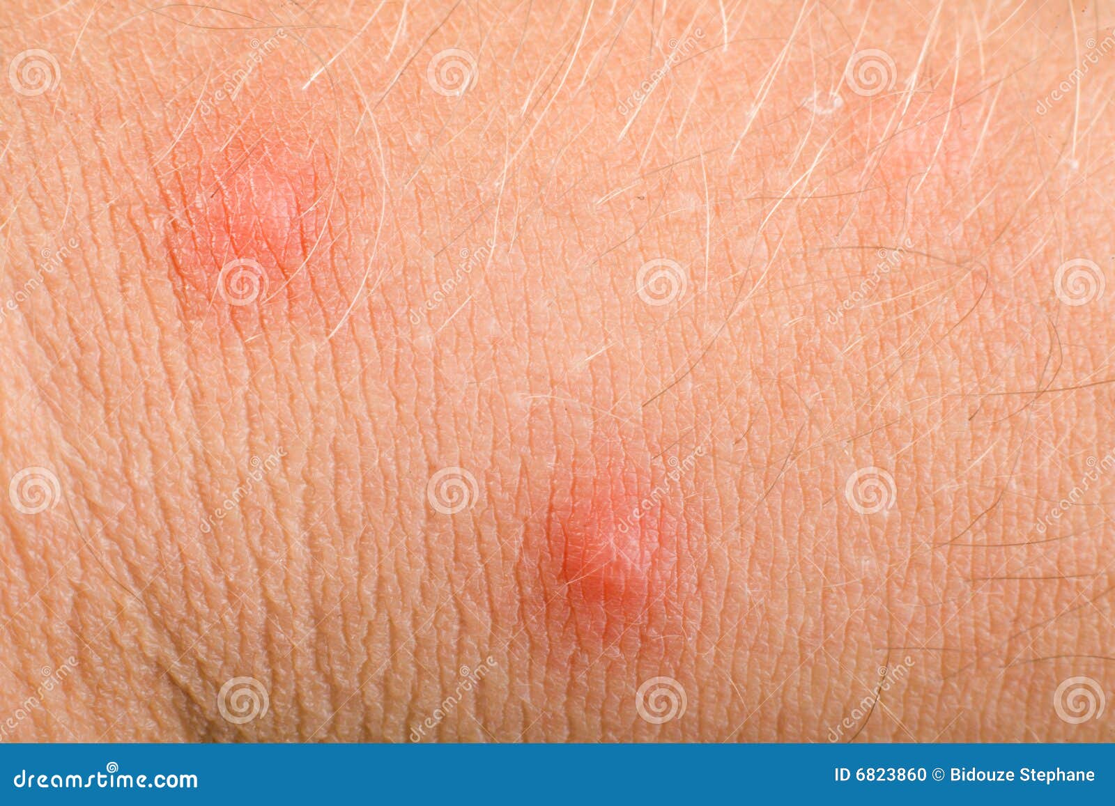 Pimples On Skin Stock Photo - Image: 6823860