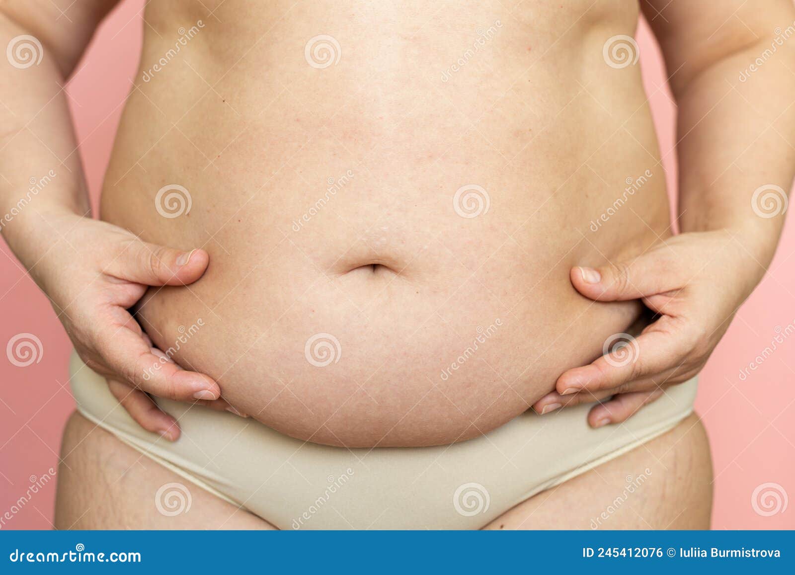 Female hanging belly with stretch marks on skin closeup. Overweight woman  flaunt figure Stock Photo by burmistrovaiuliia