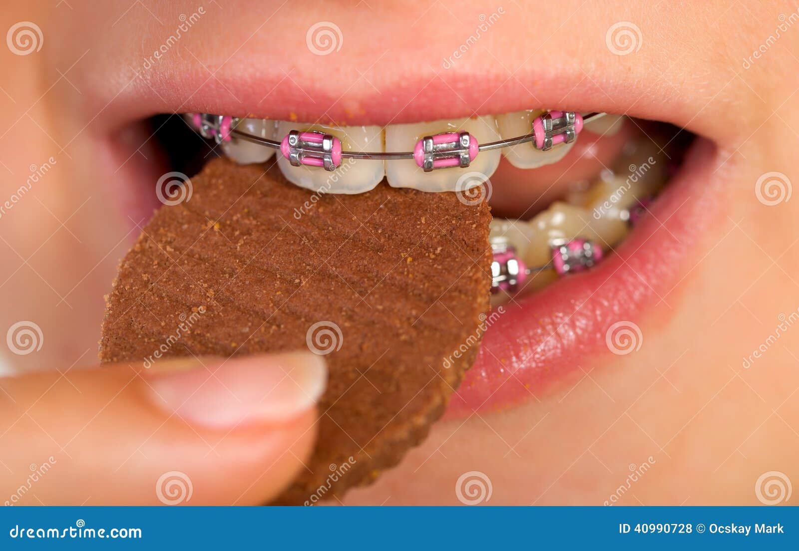 Pink braces stock photo. Image of bite, healthcare, dental 40990728