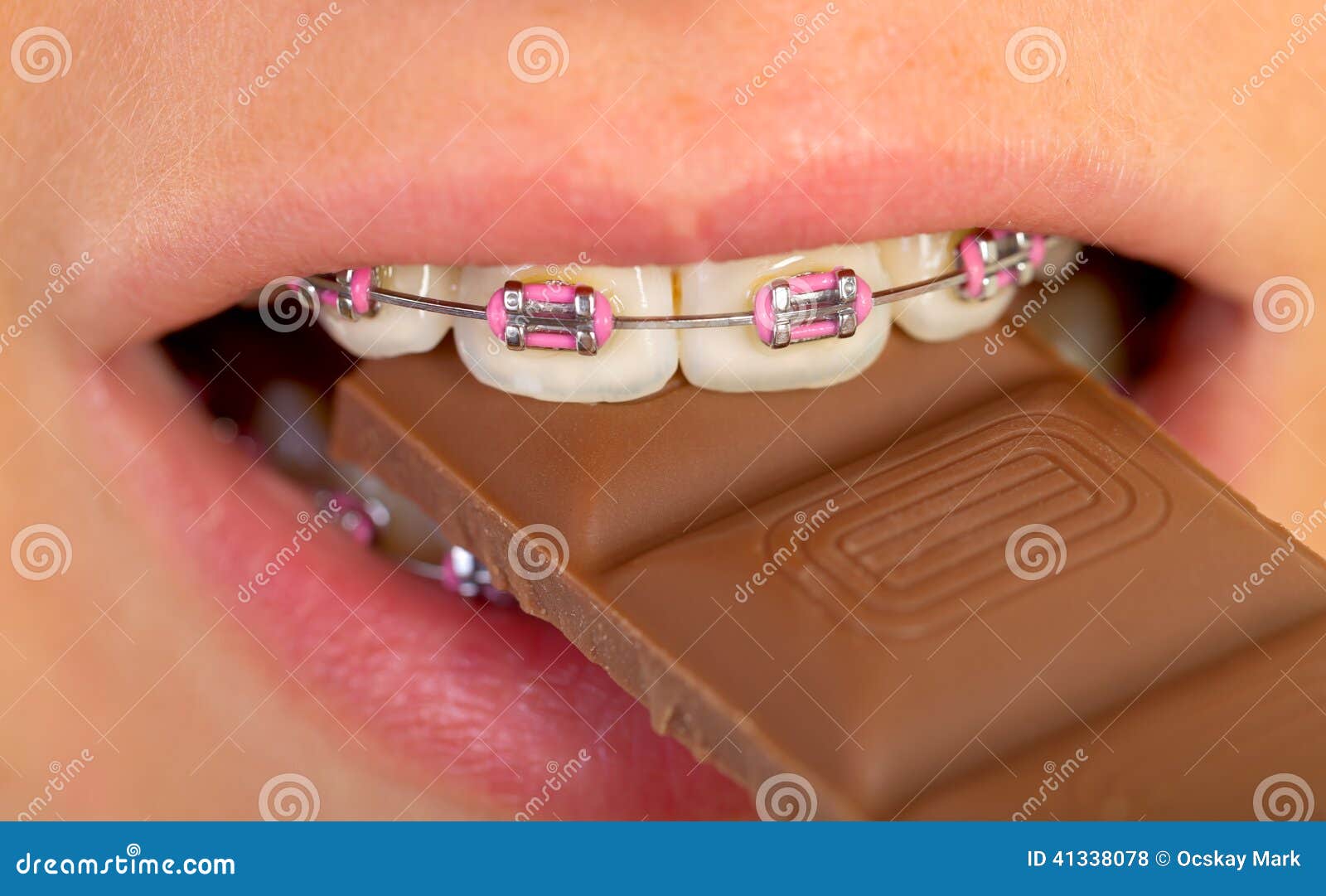Pink braces stock photo. Image of ligature, care, metal 41338078