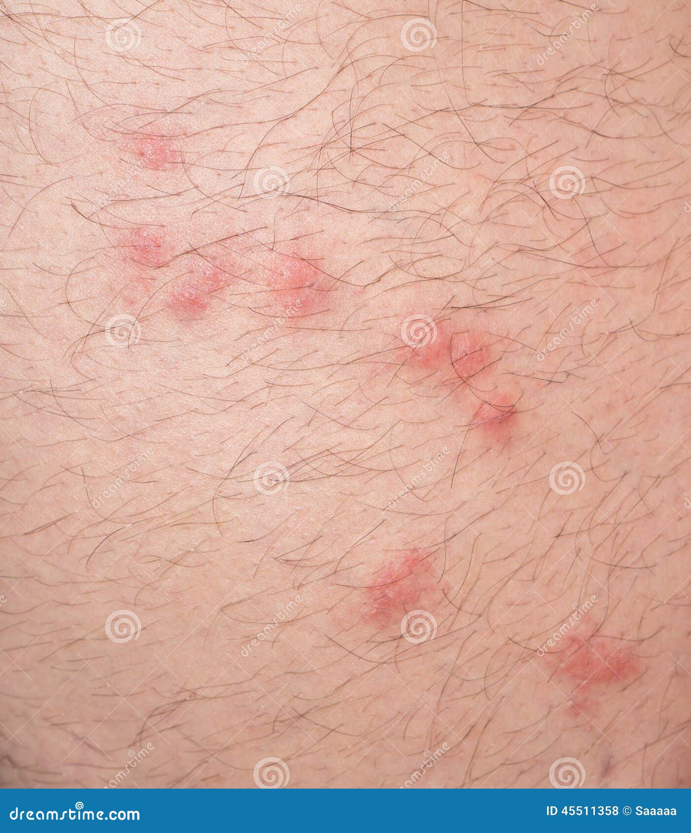 Piqures De Puce Au Dessus De Peau Velue D Homme Caucasien Photo Stock Image Du Blanc Irritant