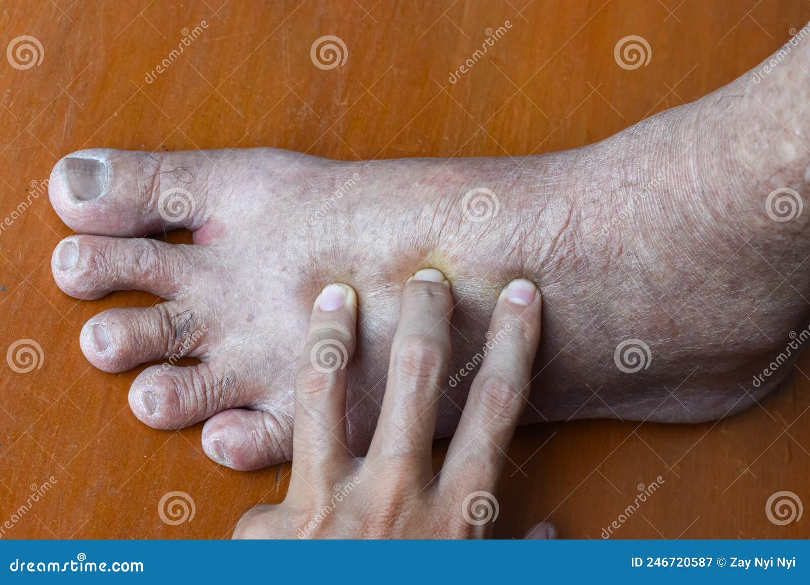 Pitting Edema Of Lower Limb Swollen Leg Of Asian Man Stock Image
