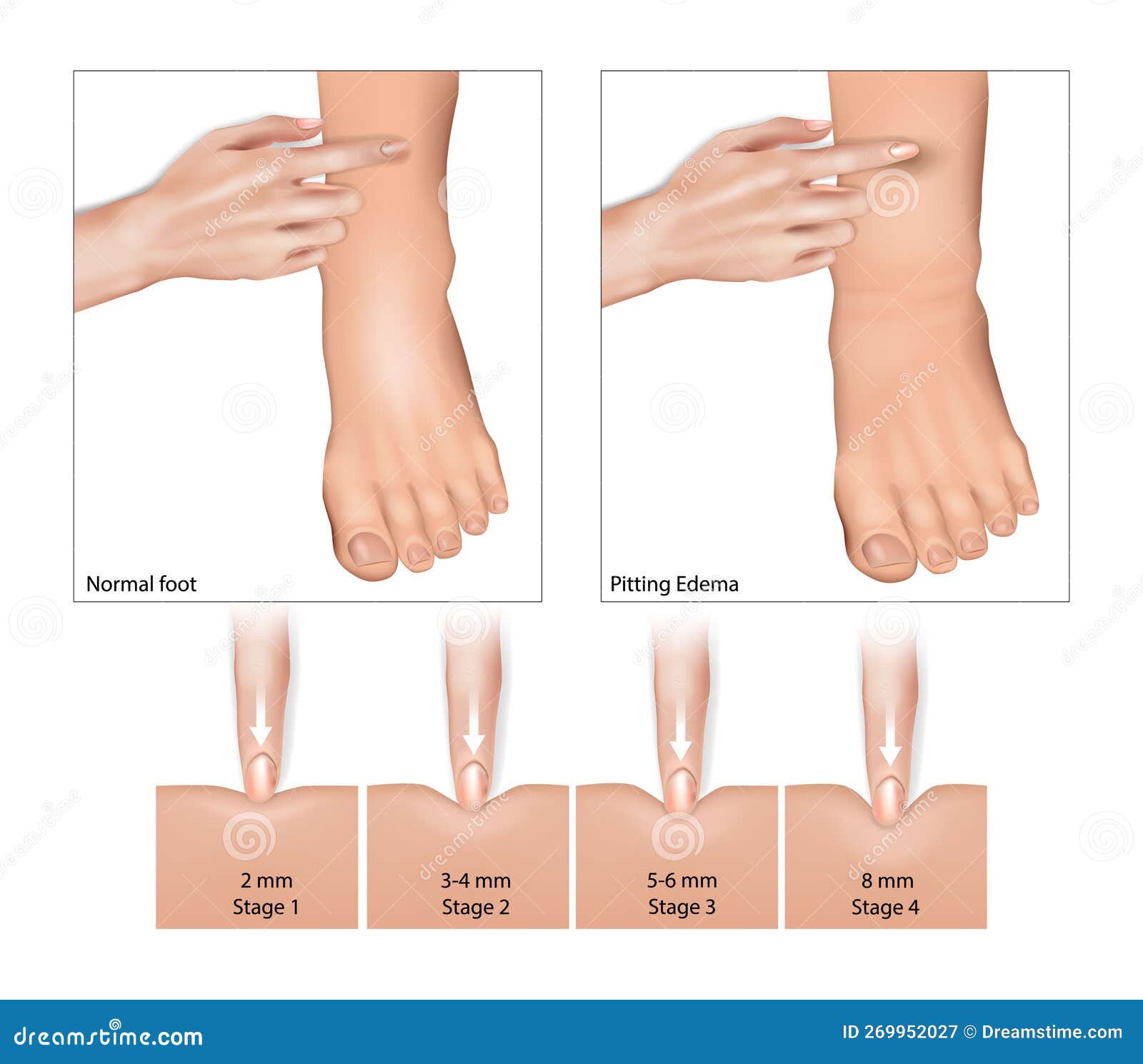 Edema Causes Symptoms Treatment 40 OFF edema-causes-symptoms-treatment-40-off