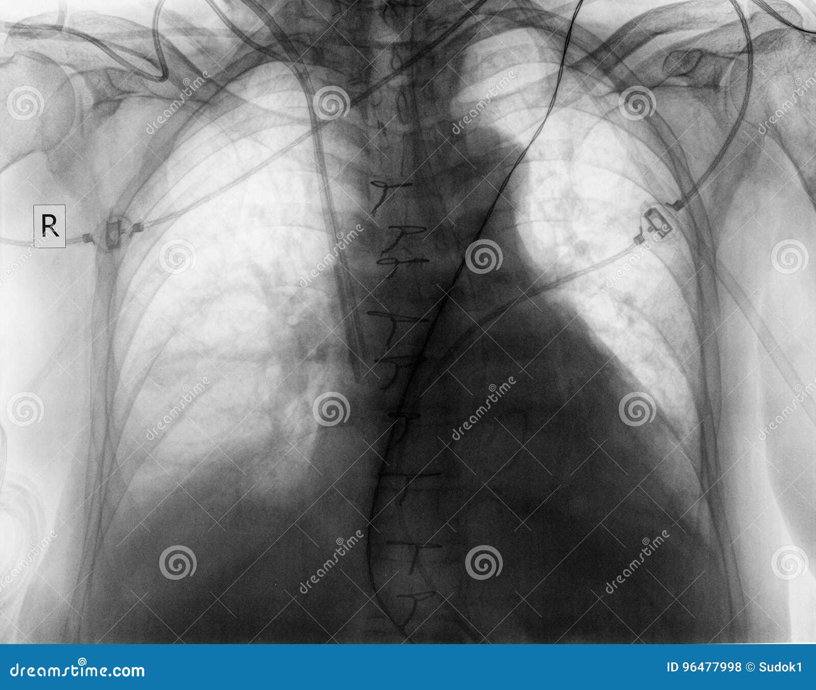 Plain Chest Radiograph of Patient after Surgery Stock Photo Image of cardiac, pathology 96477998