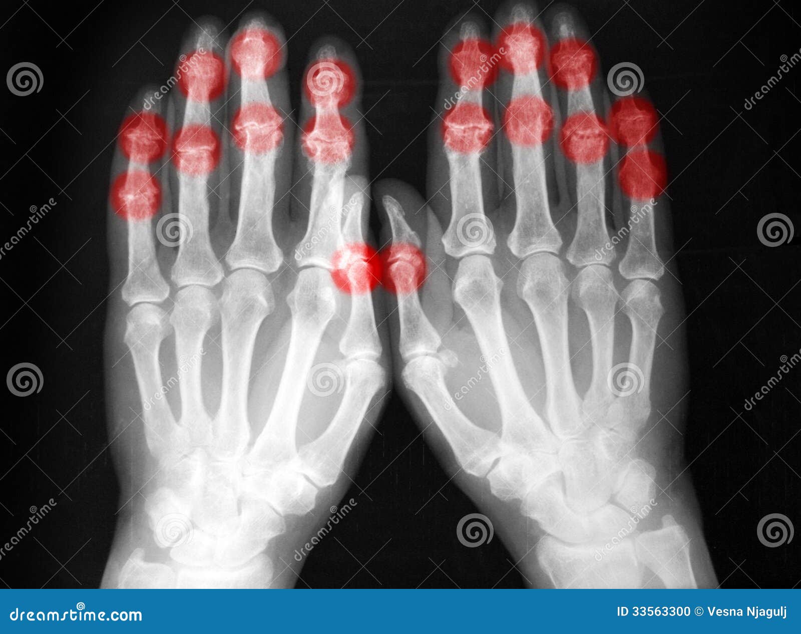 plain film, radiography, of both hands, arthritis