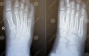 Xray Normal Foot X Ray Normal Human S Foot Lateral Stock Photo Image Xray Normal Foot X Ray Normal Human S Foot Lateral Stock Photo Image