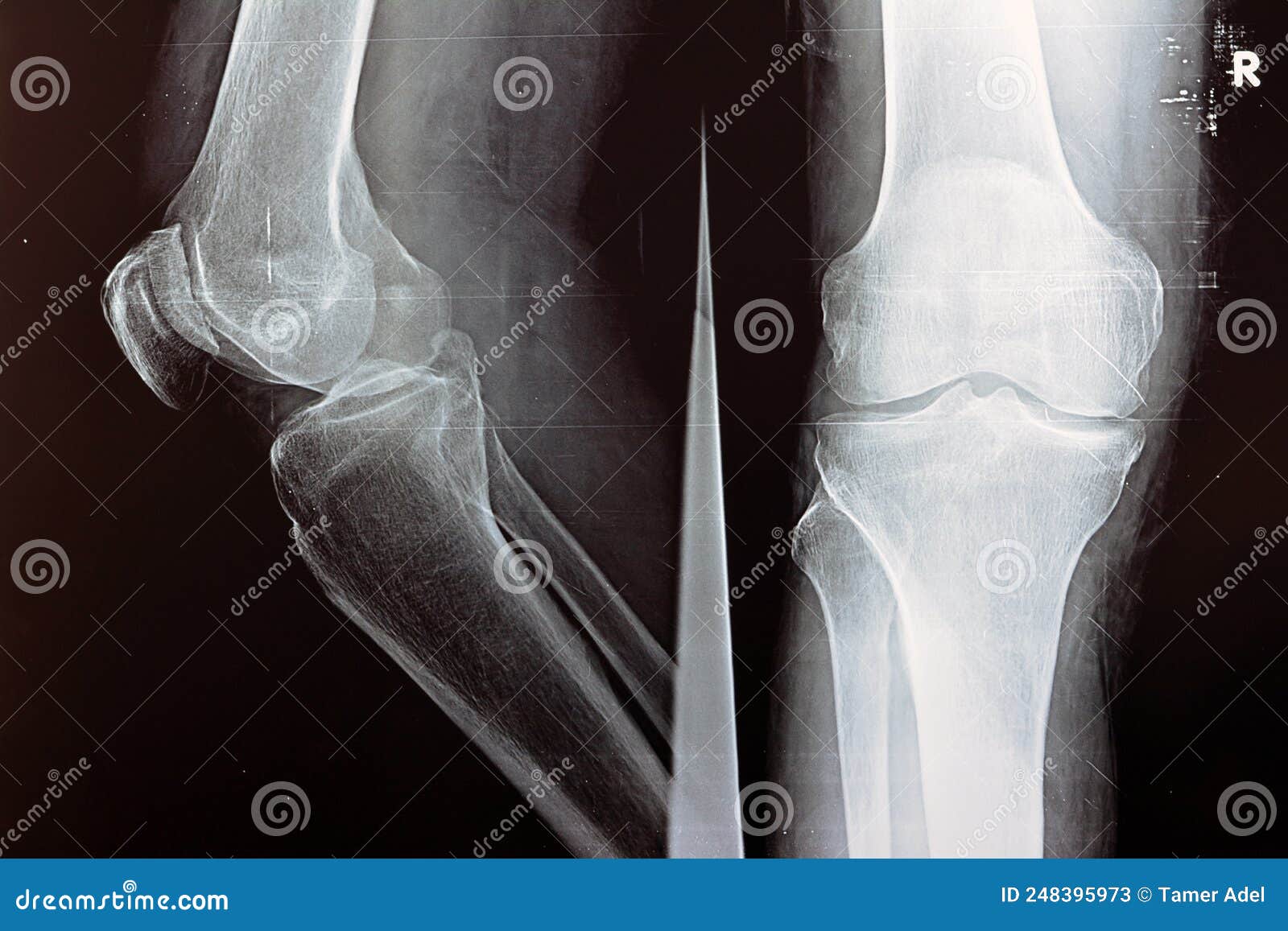 Plain X Ray of the Right Knee Shows Apparent Joint Osteoarthritis