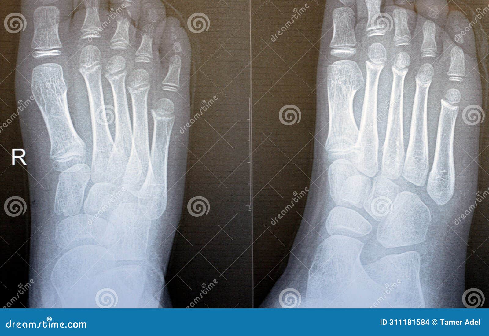 normal-xray-of-both-hands-stock-photo-cartoondealer-24374550