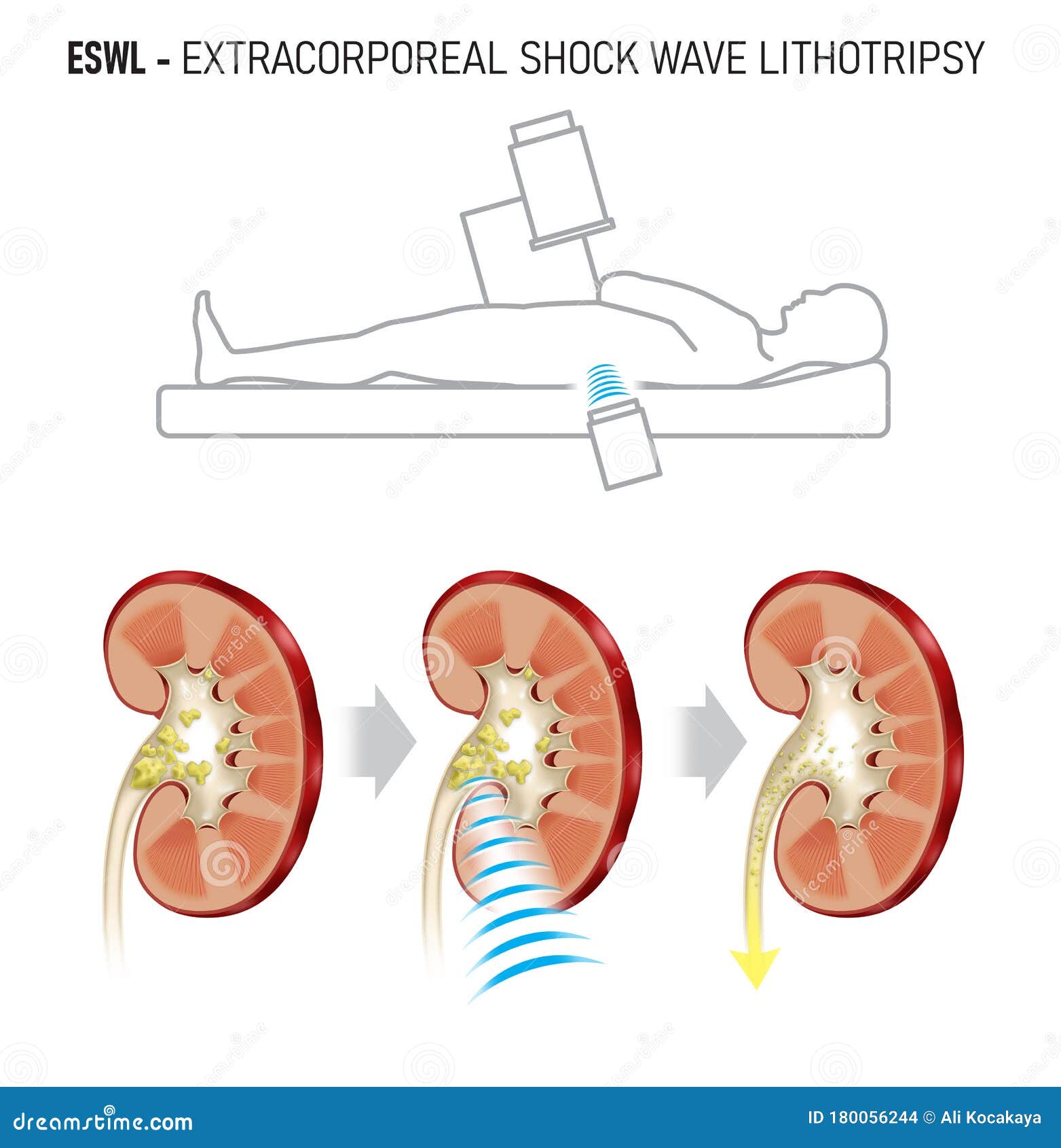 Shock Waves To Break a Kidney Stone Stock Illustration Illustration