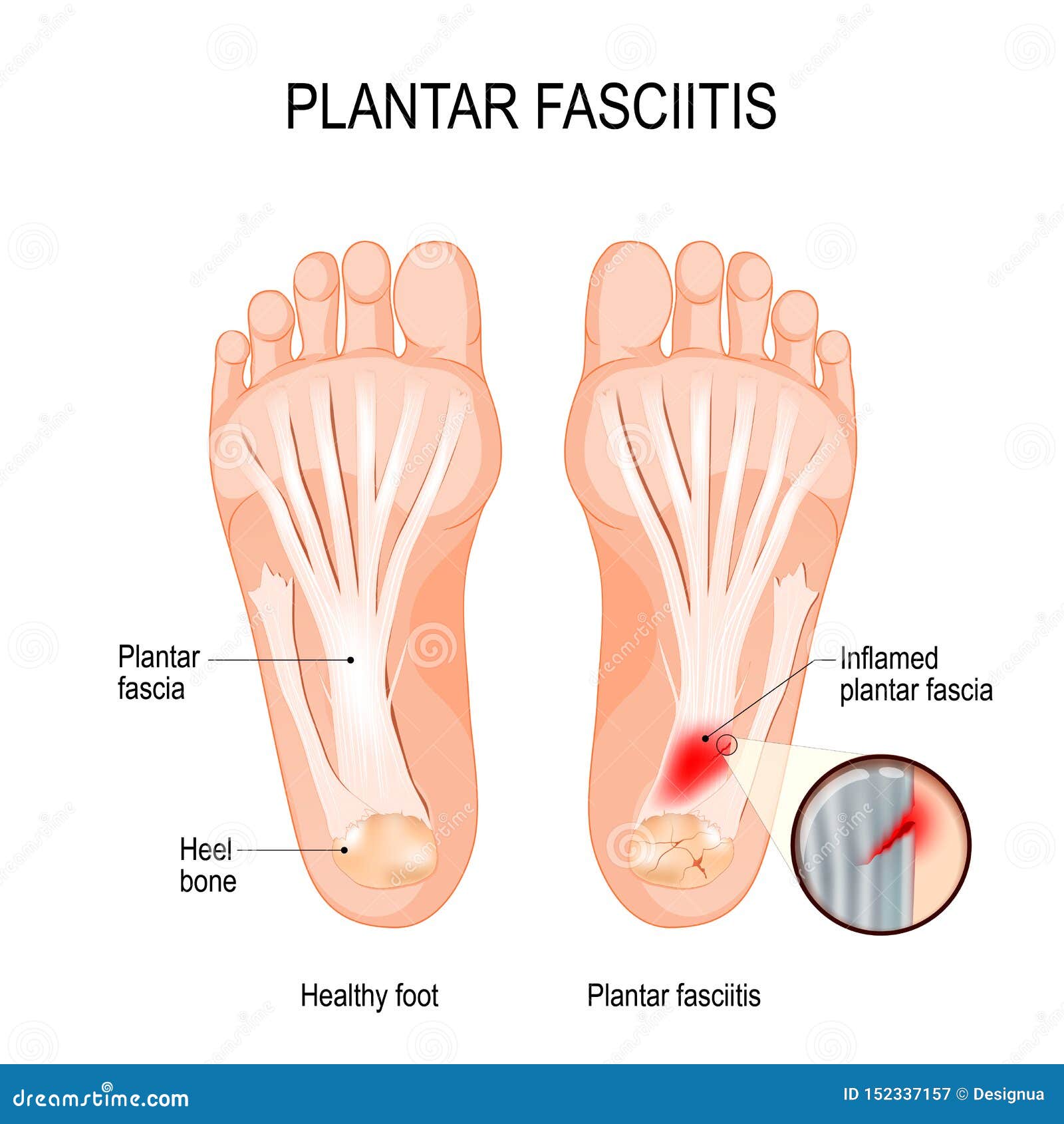 plantar fasciitis. disorder of the connective tissue which supports the arch of the foot