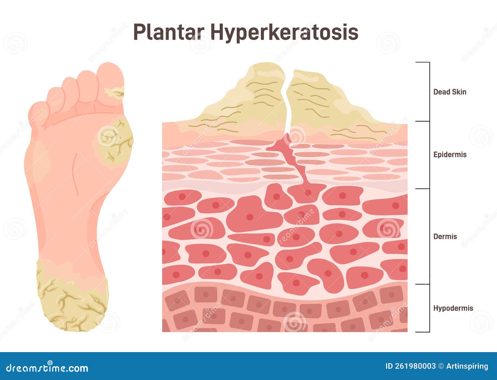 https://thumbs.dreamstime.com/z/plantar-hyperkeratosis-feet-corns-calluses-medical-condition-plantar-hyperkeratosis-feet-corns-calluses-medical-condition-261980003.jpg