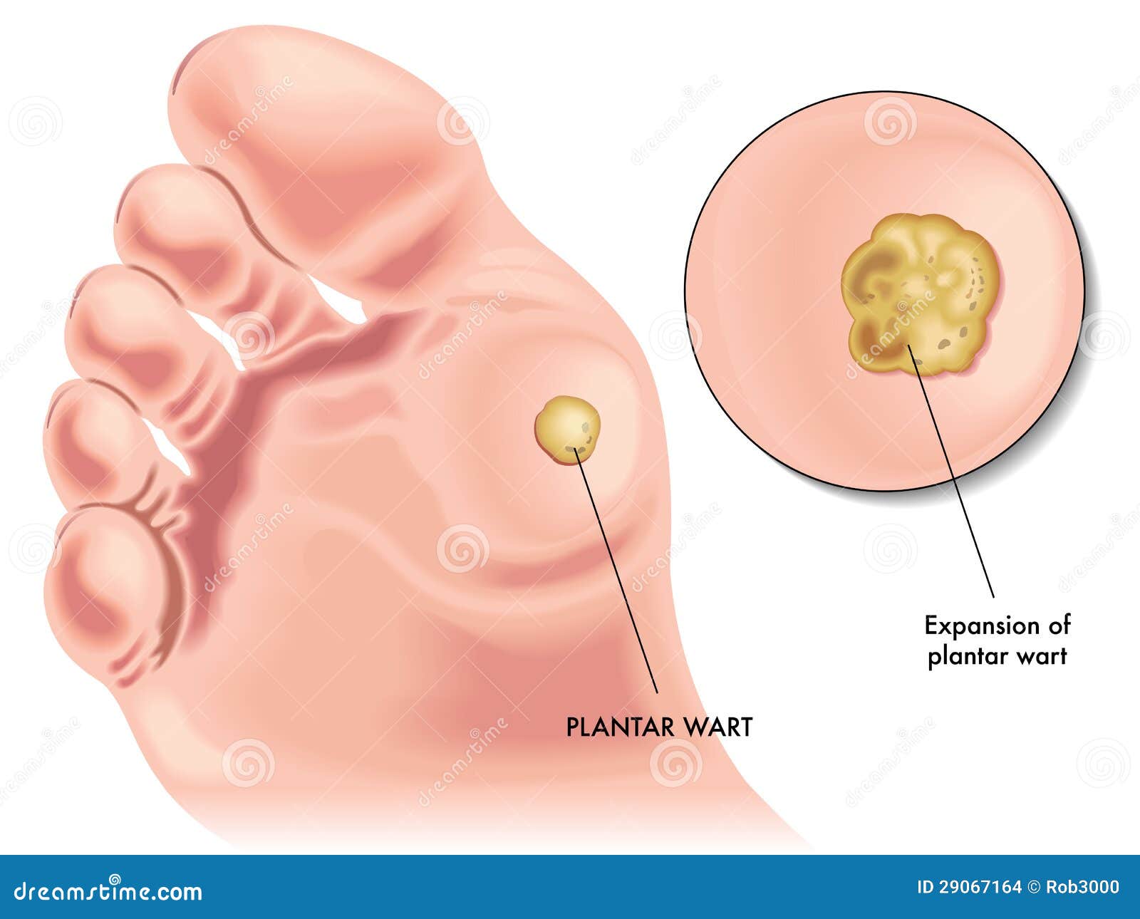 Wart Cartoons, Illustrations & Vector Stock Images 758 Pictures to