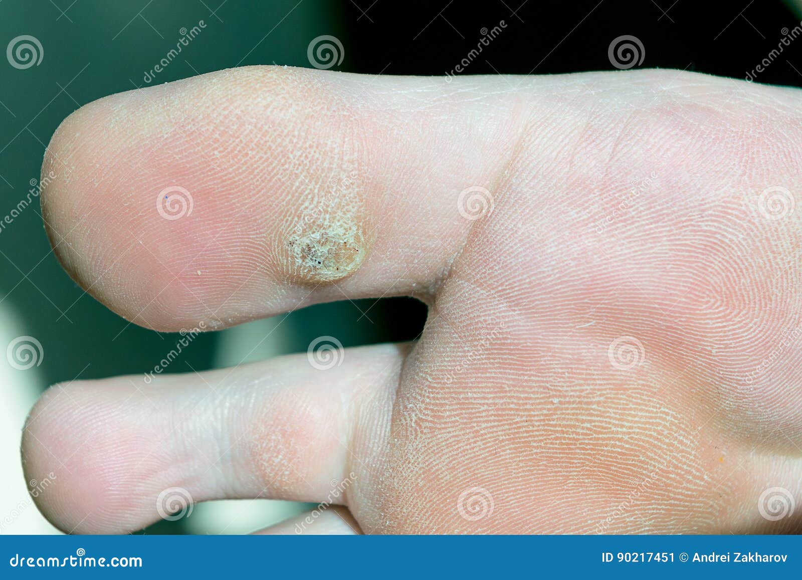 wart on foot black dots papilloma of conjunctiva