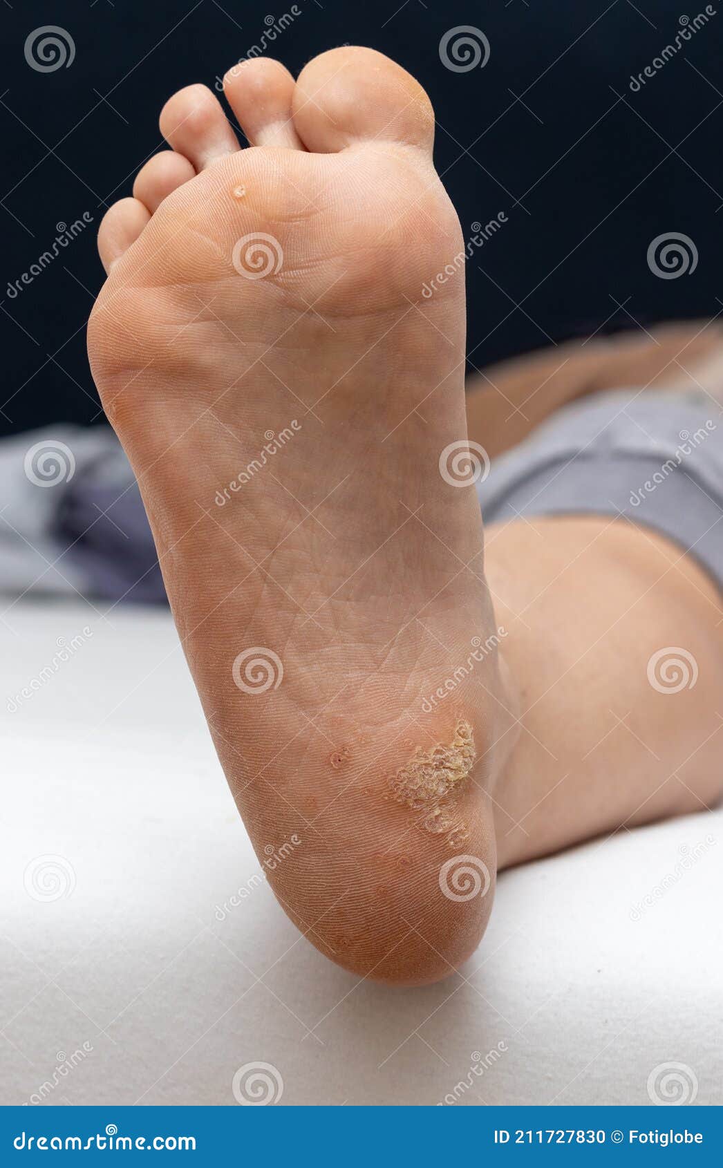 papilloma on soles of feet)