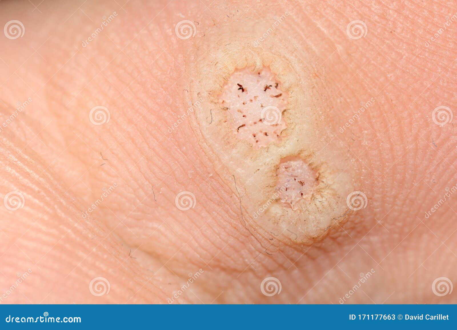 papilloma warze bilder