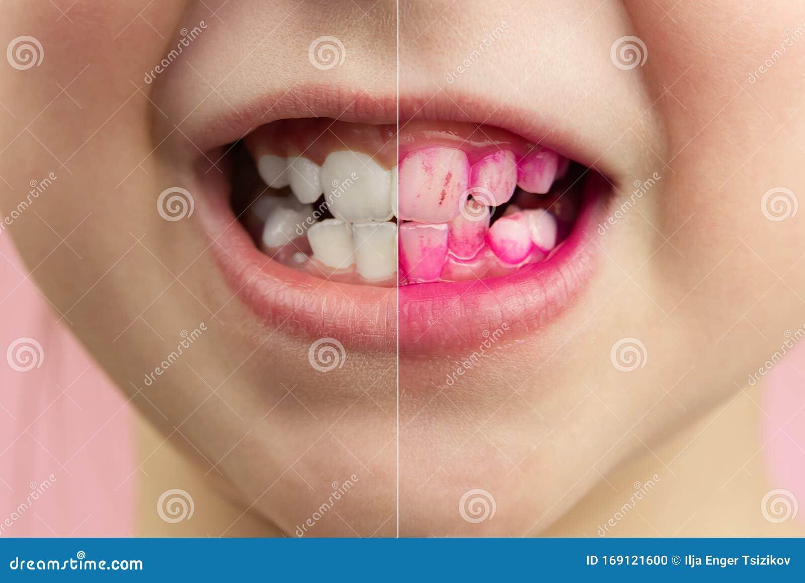 plaque disclosing tablets in work. before and after - effect. close up photo of young girl tooth. dental plaque pill