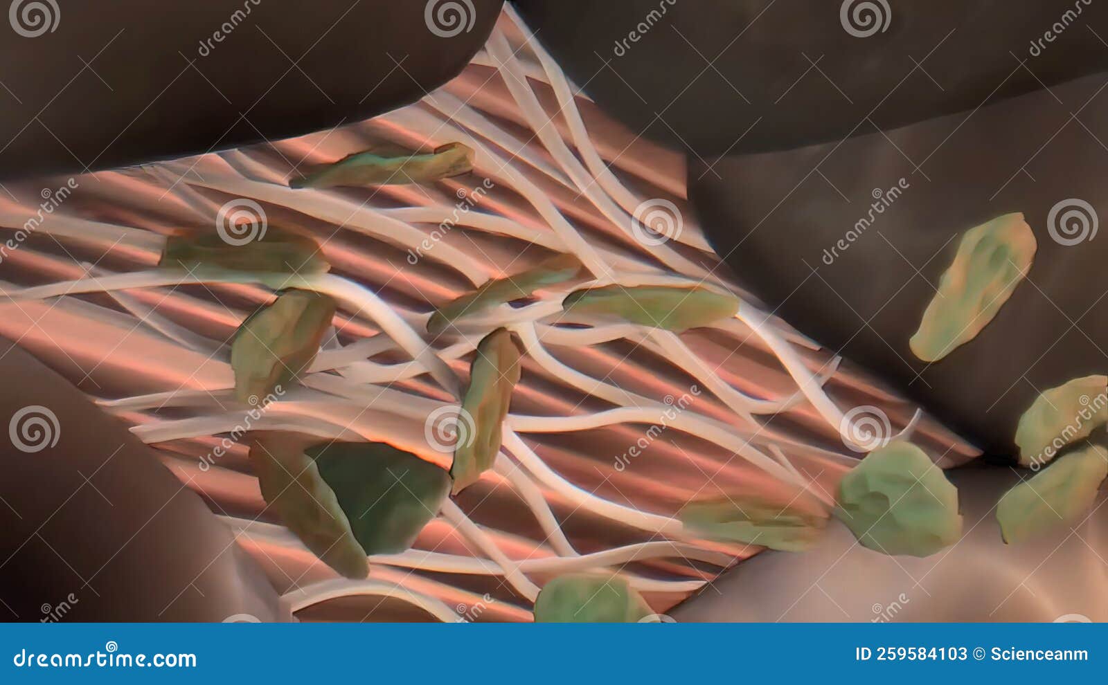 Plaque Formation in the Cardiovascular System Stock Illustration