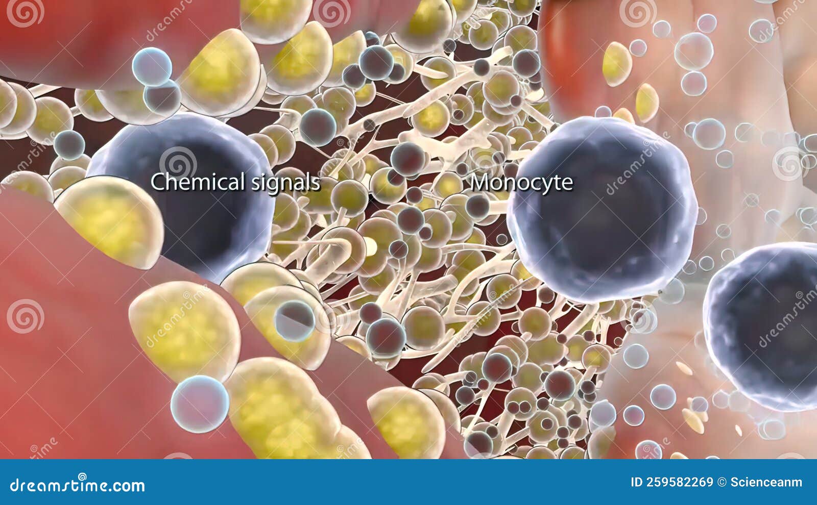 Plaque Formation in the Cardiovascular Tract Stock Illustration