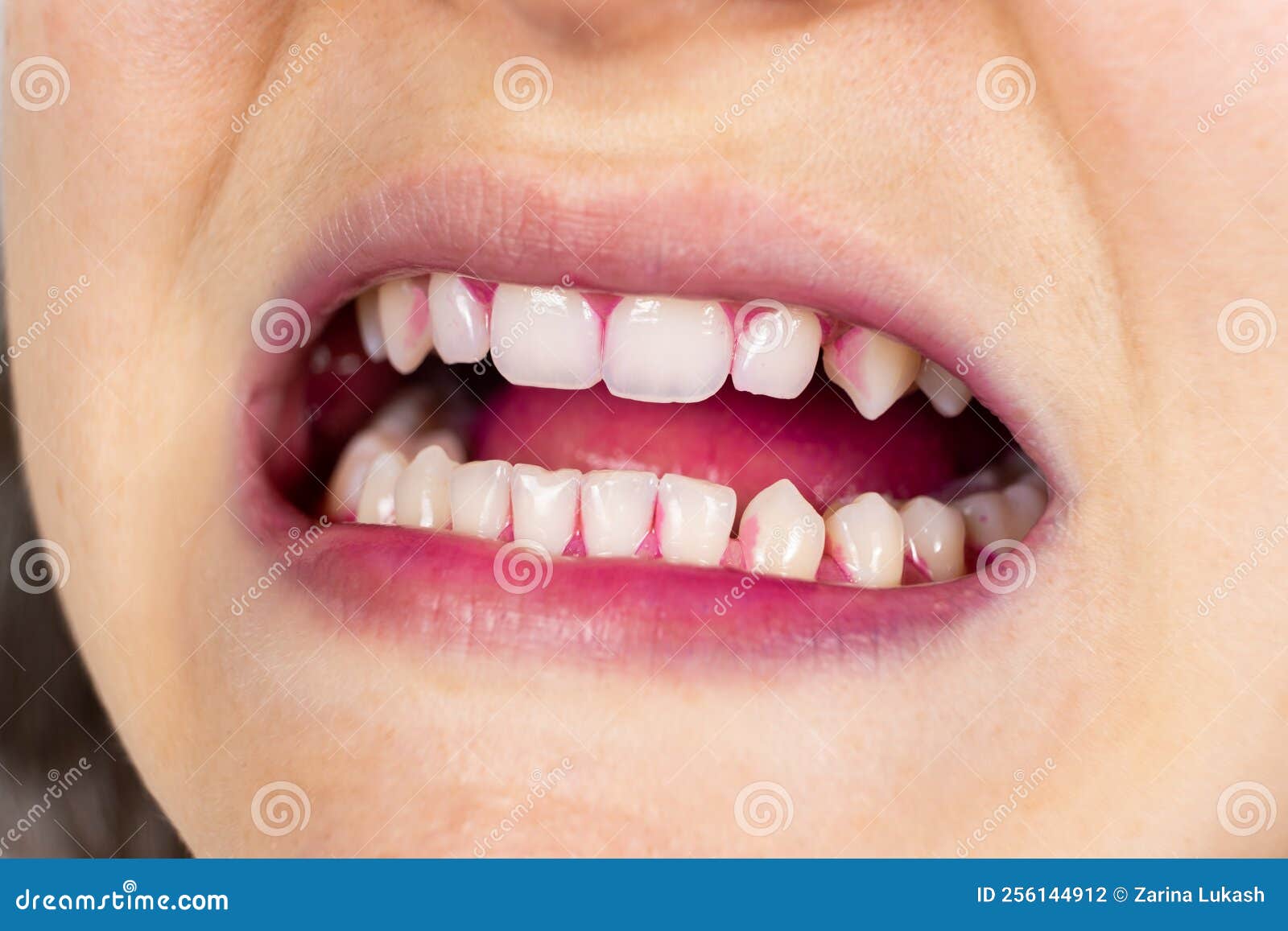 Plaque on Human Teeth is Colored Pink with Indicator Tablets. Stock