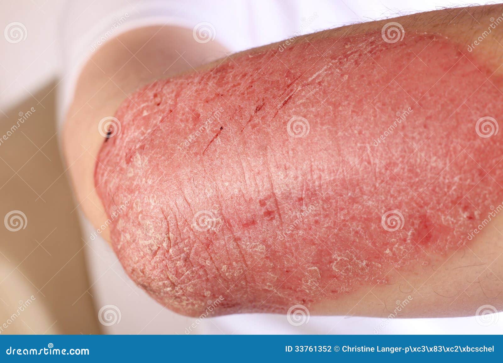 plaque psoriasis inflammatory disease