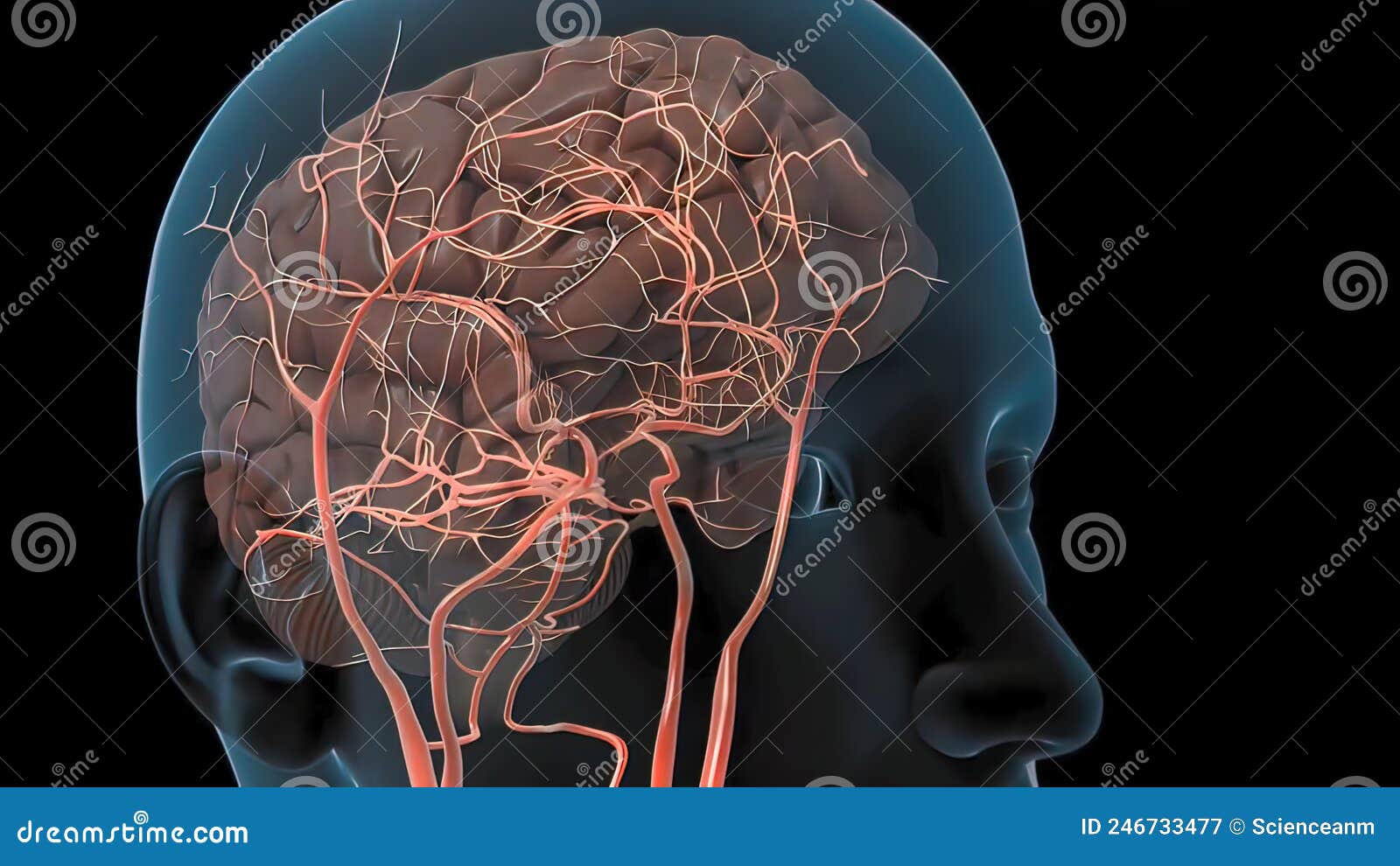 The Plaques Contain Atheroma, a Fatty Substance Composed of Dead White