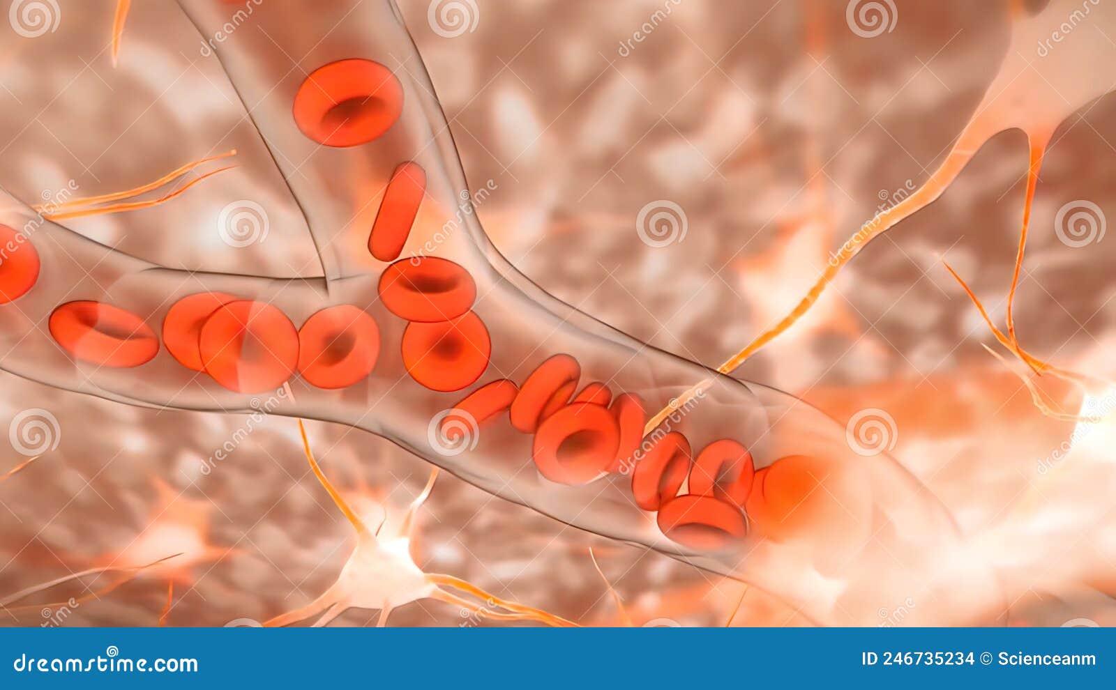 The Plaques Contain Atheroma, a Fatty Substance Composed of Dead White