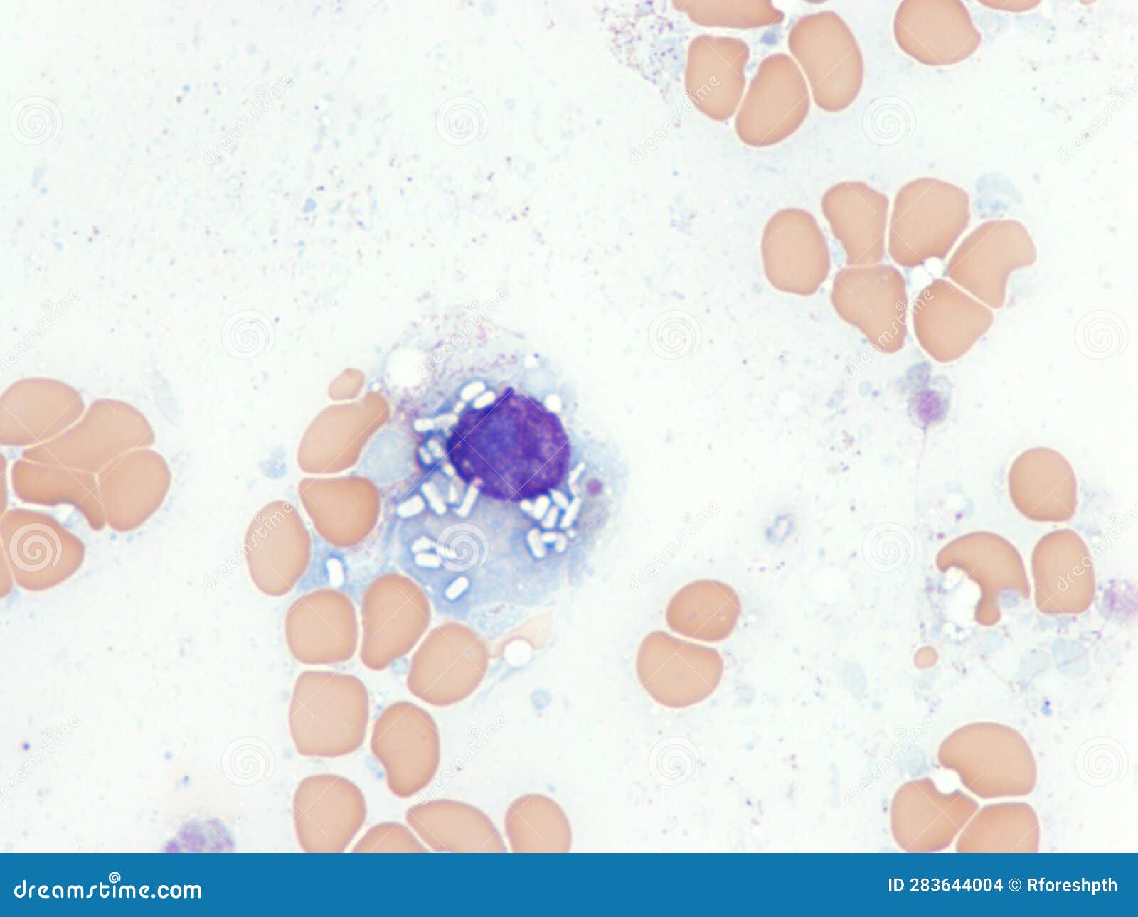 plasma cell with crystalline inclusions in the cytoplasm.