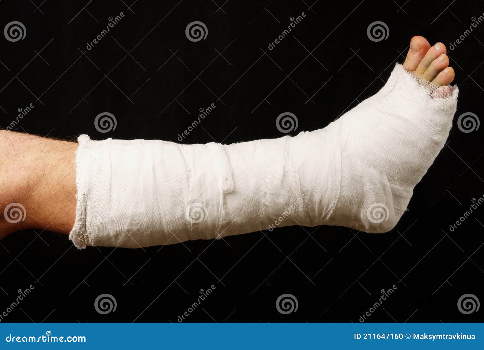 Plaster Cast on the Leg on a Black Background Stock Photo Image of