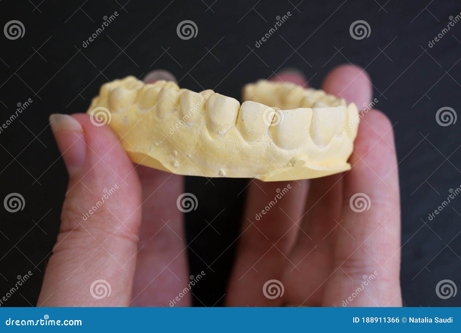Plaster Cast of Teeth. Future Implants Stock Photo Image of