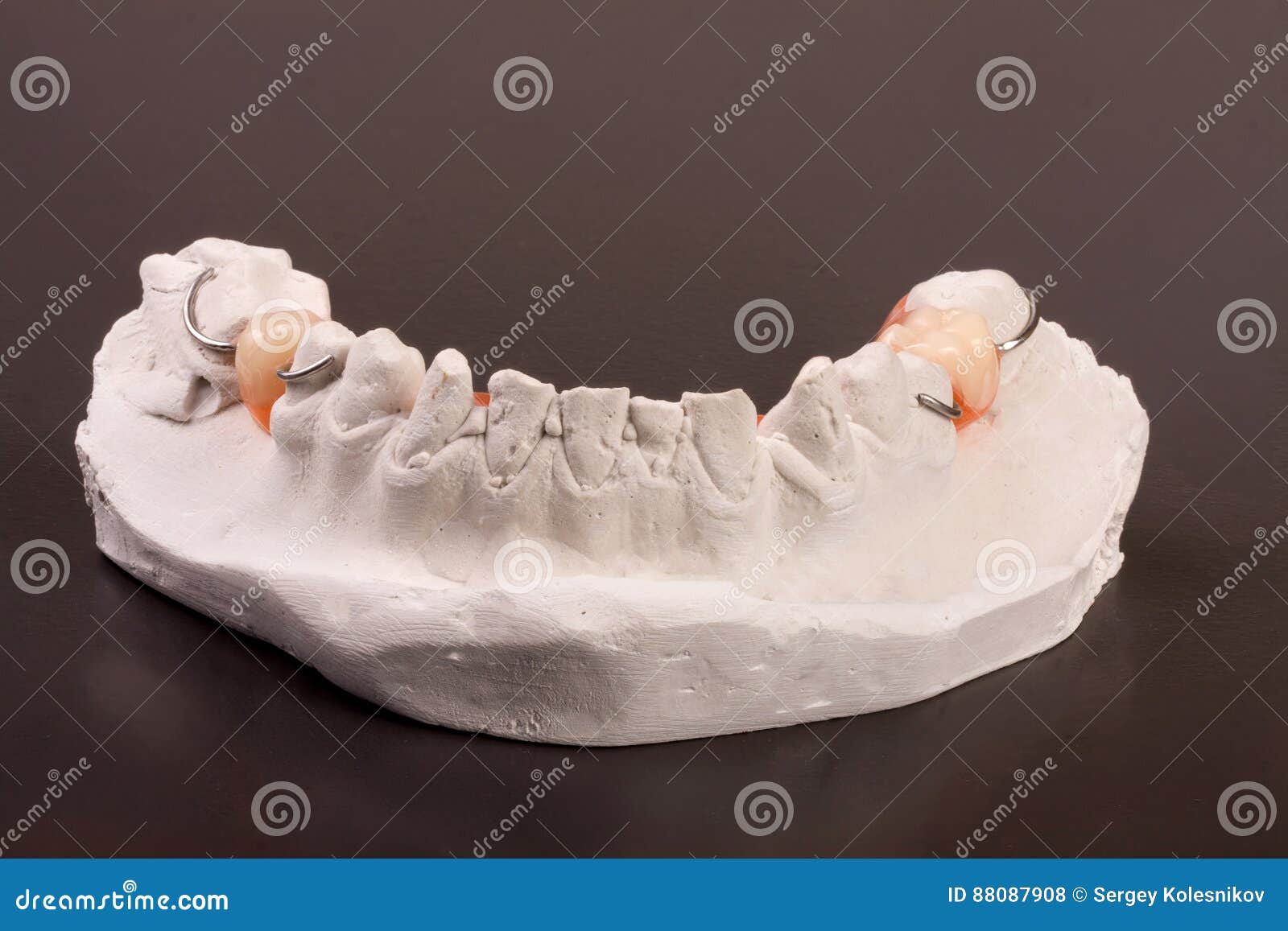 Plaster Cast of Teeth with Removable Partial Denture on a Dark