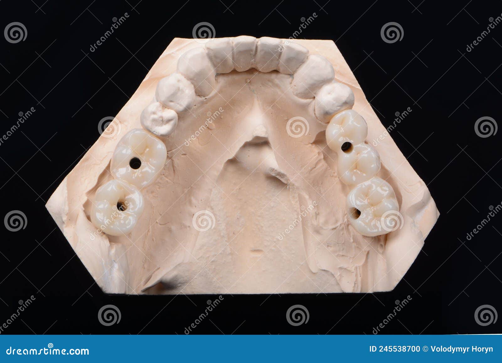 Plaster Lower Jaw Model with Zirconia Teeth on Implants. Process of