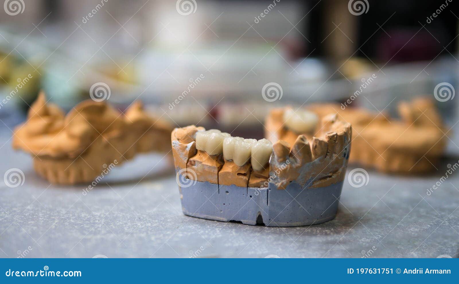 Plaster Model of Teeth on a Work Table,a Dental Technician Makes a