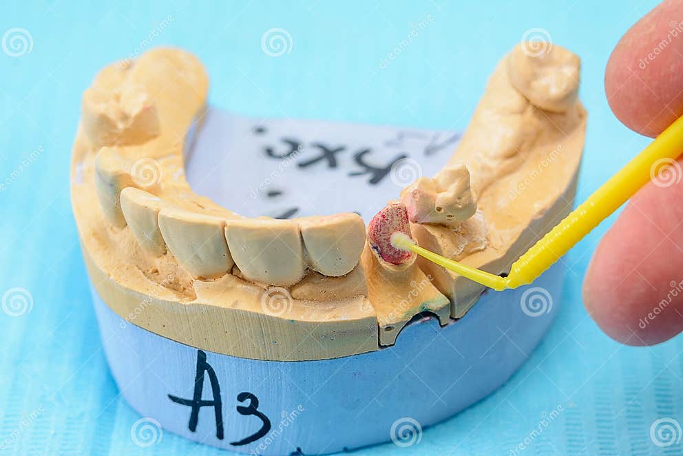 Plaster Models of the Jaws in the Hands of a Dental Technician in a