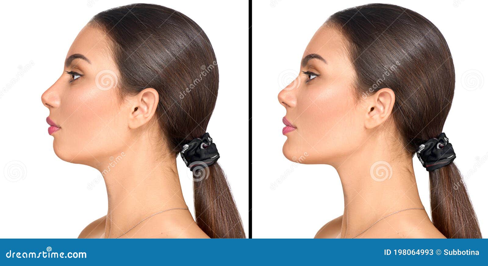 before and after plastic surgery of a chin. cosmetic correction small weak chin, plastic surgery of a chin, reduction surgery