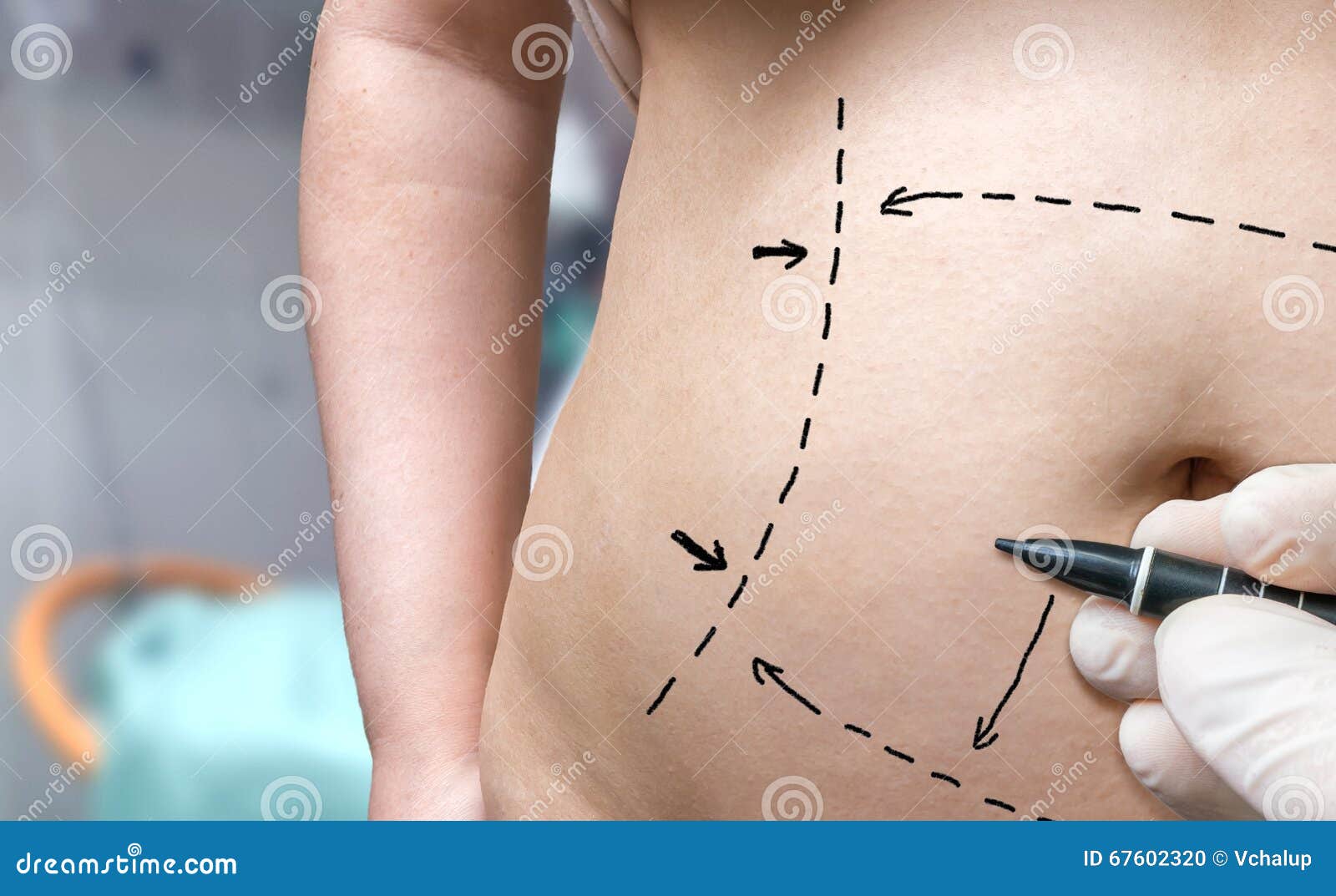 Plastic Surgery Concept. Hand Is Drawing Lines With Marker On Belly
